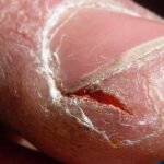Лечение народными средствами ногтевого грибка на руках и ногах
