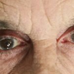 Лечение катаракты народными средствами без операции: рецепты нетрадиционной медицины
